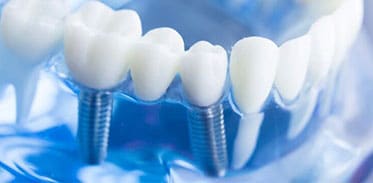 Dental Implants